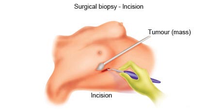 Surgery_Incisional_Excisional_Biopsy