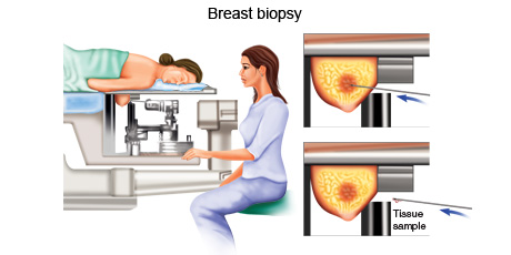 Breast Biospy