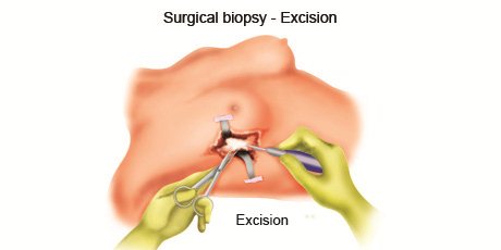 Surgery_Incisional_Excisional_Biopsy_1