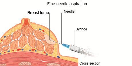 Fine Needle Aspiration 