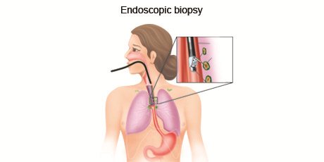 Endoscopic_Biopsy