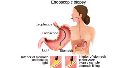 Endoscopic_Biopsy1